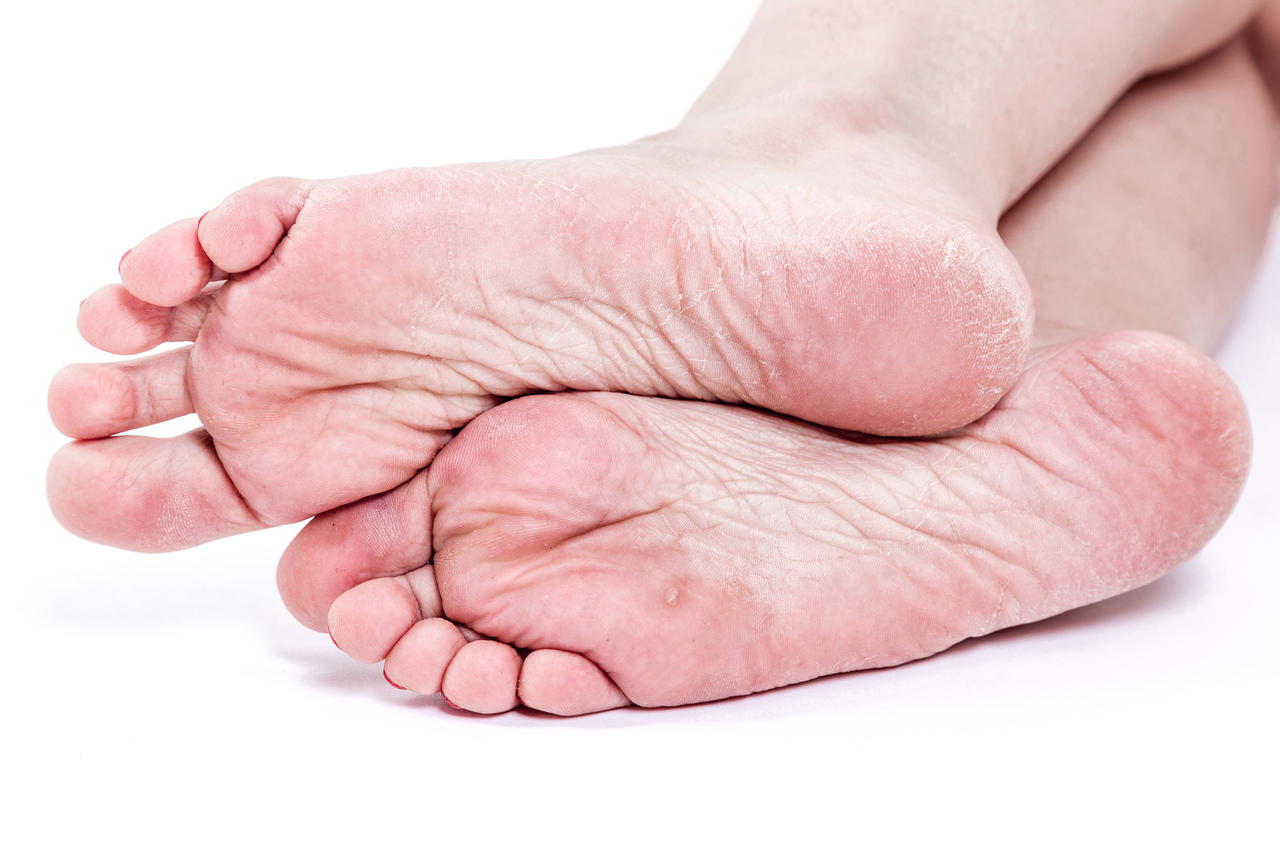 O que é úlcera do pé diabético? 